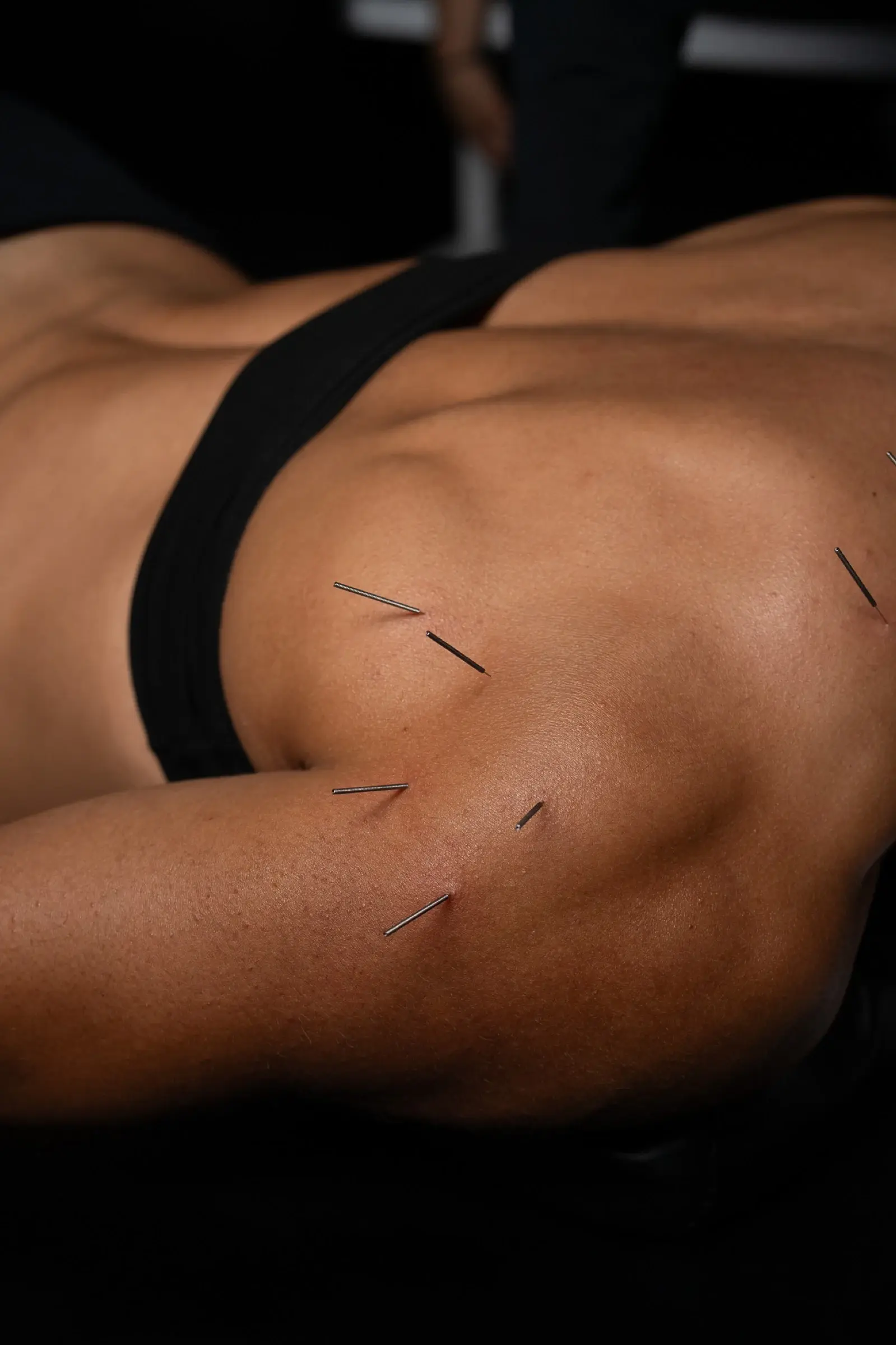 Dry needling along the scapula and upper back shoulder at PROS