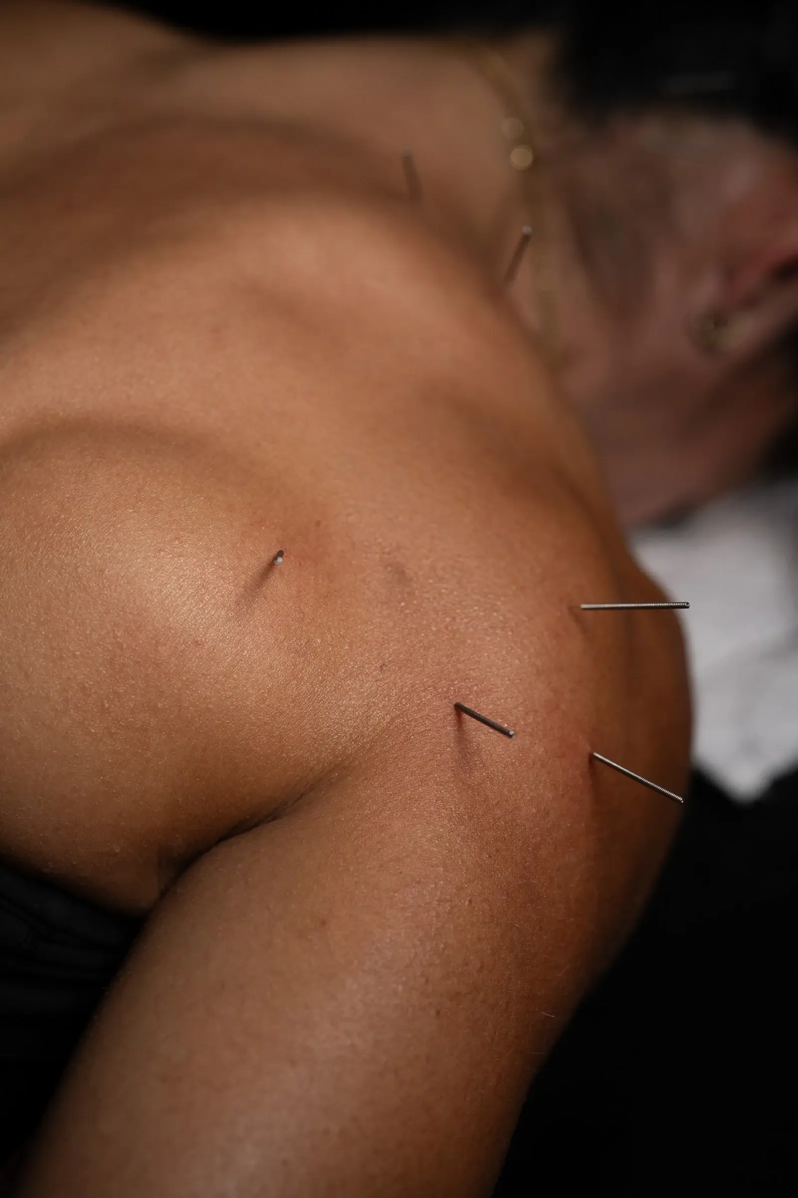 Dry needling filiform needles in the shoulder and deltoid at PROS